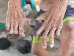 Tercatat 213 Kasus Baru Penyakit Kusta di Provinsi Gorontalo