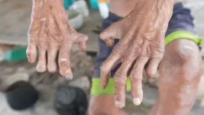 Tercatat 213 Kasus Baru Penyakit Kusta di Provinsi Gorontalo